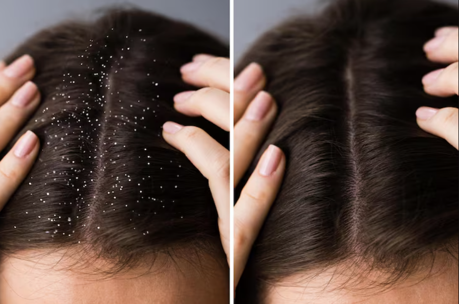 Anti dandruff treatment before and after